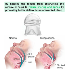 Anti-Snoring Tongue Retainer - Stop Snoring Instantly